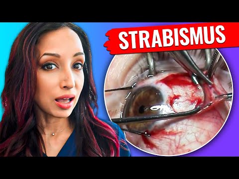 What Is Adjustable Suture Strabismus Surgery? Eye Doctor Explains