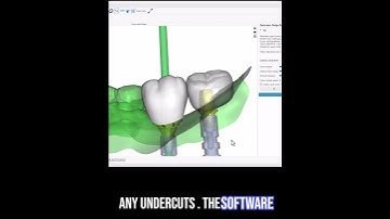 2 Adjacent Titanium Base Crowns. Free! #dentalcrowns #digitaldentistry #dentistry