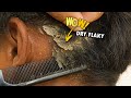 Scratching Dandruff Dry Flaky Scalp With A Black Comb #377