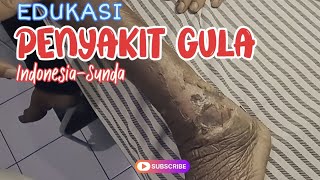 Download Lagu EDUKASI PENYAKIT GULA VERSI SUNDA - BAHASA ! #ruralhealthcare #syarhan MP3 Download Lagu EDUKASI PENYAKIT GULA VERSI SUNDA - BAHASA ! #ruralhealthcare #syarhan MP3