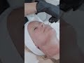 CO2 Facial Experience in Spring Hill TN | Advanced Skin Resurfacing & Anti-Aging Near Nashville