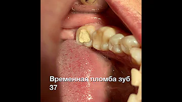 Лечение каналов зубов