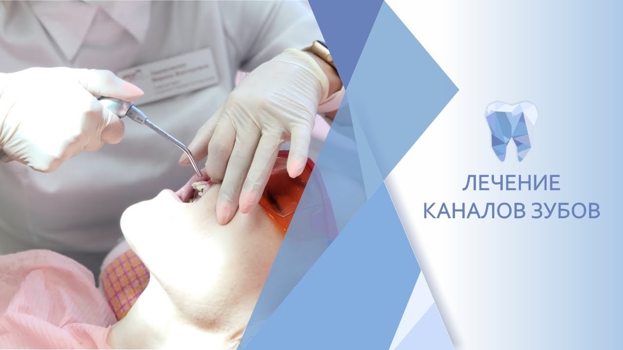 Лечение каналов зубов