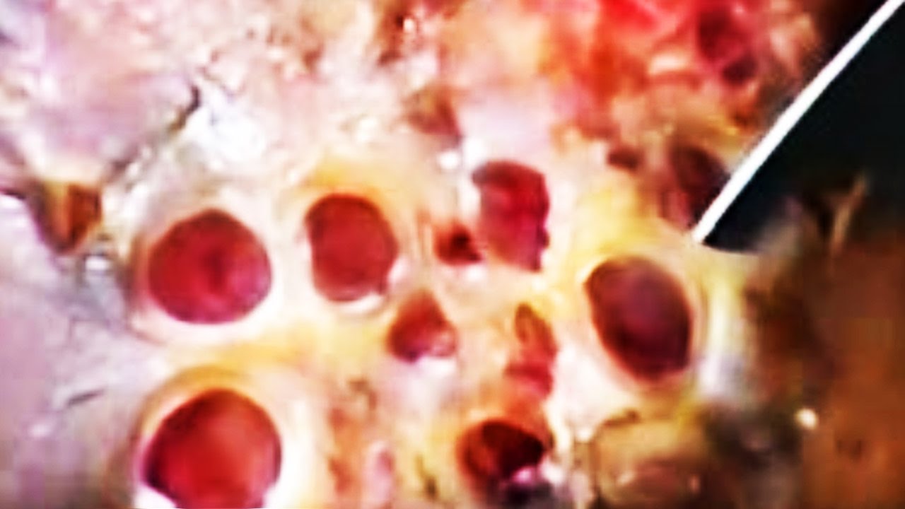 Cynthia's Deep Foot Jigger Removal! (Trypophobia Trigger) - YouTube