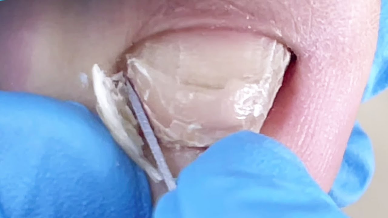 Atrophied toes and atrophy of the nail bed【Pedicure Master Lin Jun