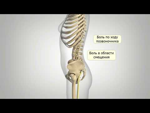 Спондилолистез: причины и симптомы