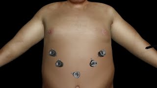 Sleeve Animation, Grand Strand Bariatric Surgery