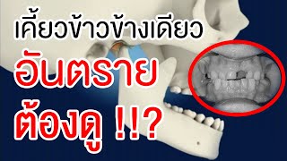 เคี้ยวข้าวข้างเดียวอันตรายต้องดู !!? | คลายปัญหาฟันกับหมอโชค