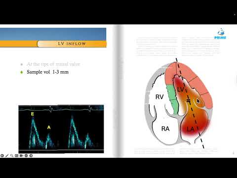 Mastering Diastolic Function Assessment 🫀 | Case-Based Echocardiography Made Simple!