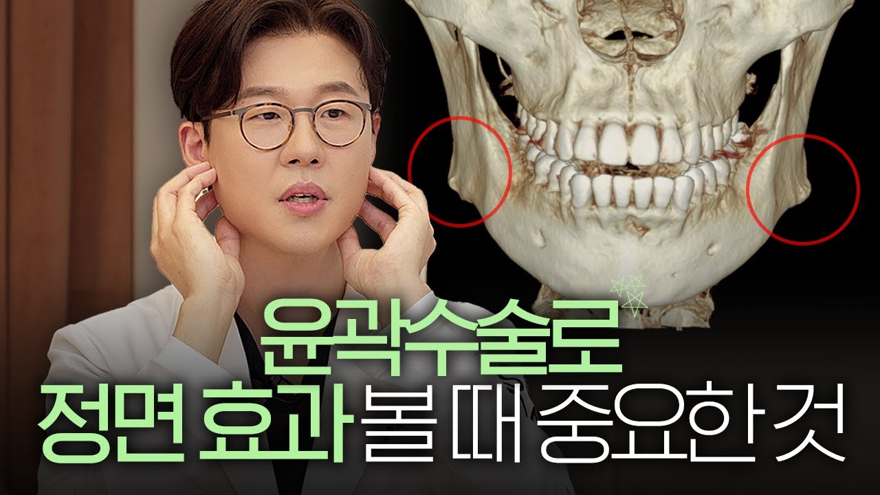 사각턱 타입별 정면에서도 수술 효과 보는 법 | 사각턱수술, 피질절골 - YouTube