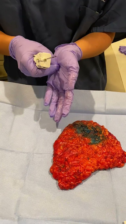 This Is How We Biopsy A Breast Tumor After Mastectomy