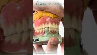 Full Upper Denture, Lower Partial #dentures #missingtooth #dentist #over50