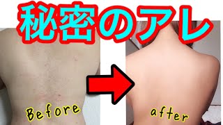 【神様】頑固な背中ニキビを一掃しました。