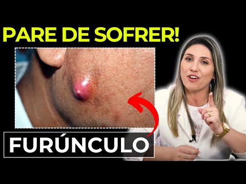 CONHEÇA A MELHOR POMADA PARA FURÚNCULO [REVELADO]