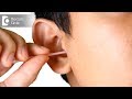 How to get rid of itchy ears? - Dr. Satish Babu K