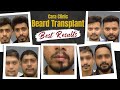 Best beard transplant results in india  before  after