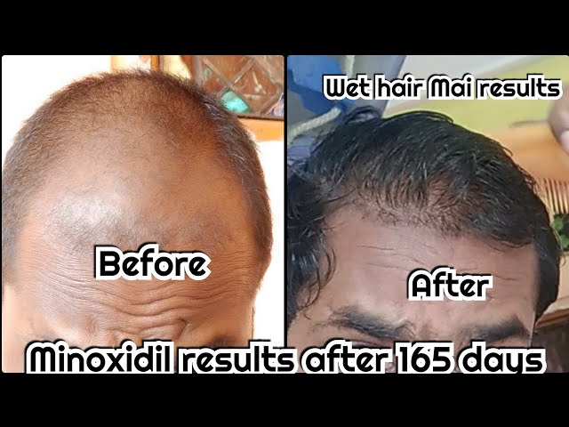 Erfaren person Mission Trampe Minoxidil results in wet hair. After 145 days of use. #Morrf 10% #Hair4u 5%  #Minoxidil #Mintop - YouTube