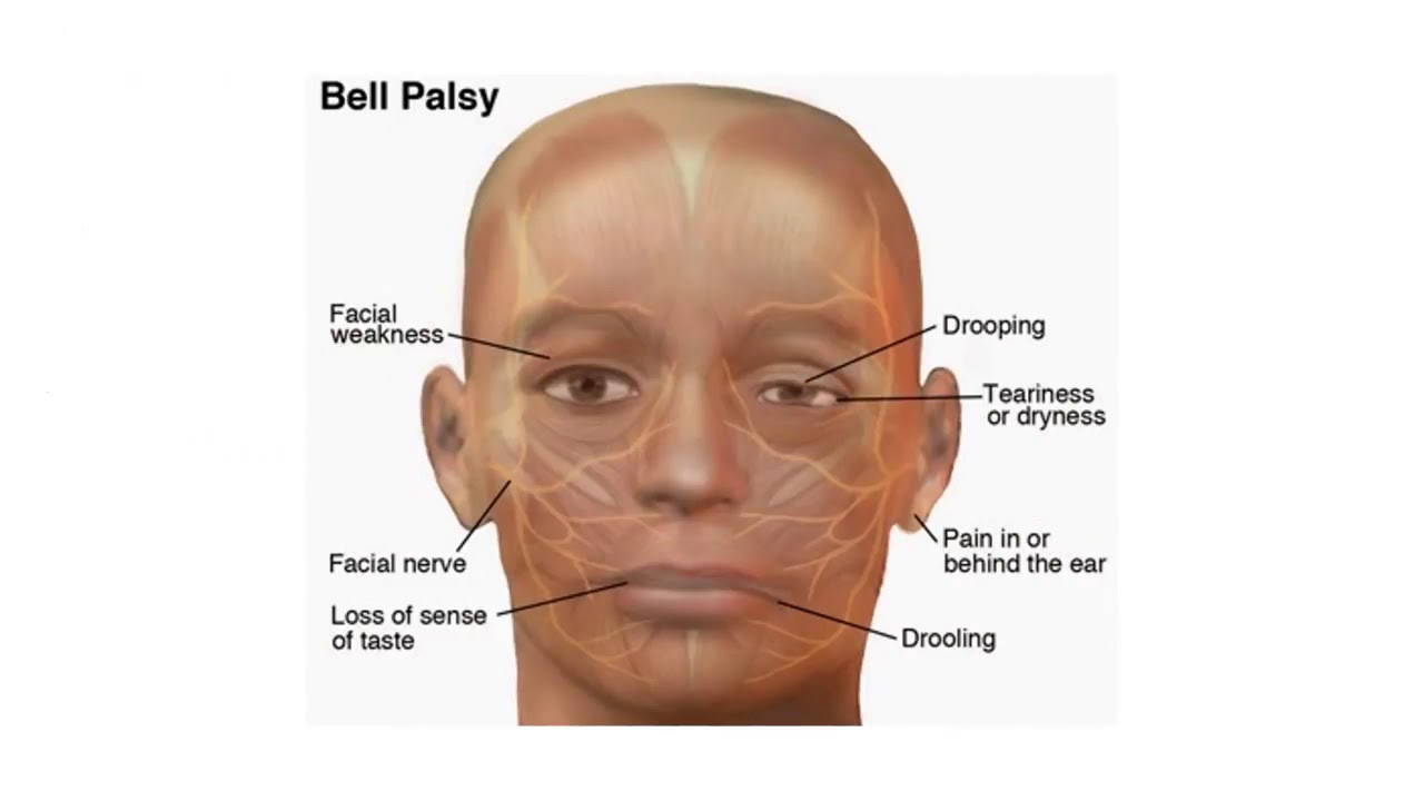 Stroke Stroke pakkavatham reasons and cure in Tamil YouTube