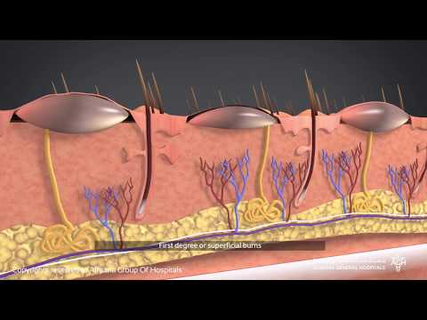 فيديو: كيفية علاج الحروق من الدرجة الثالثة (بالصور)