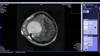 BRAIN MRI.avi