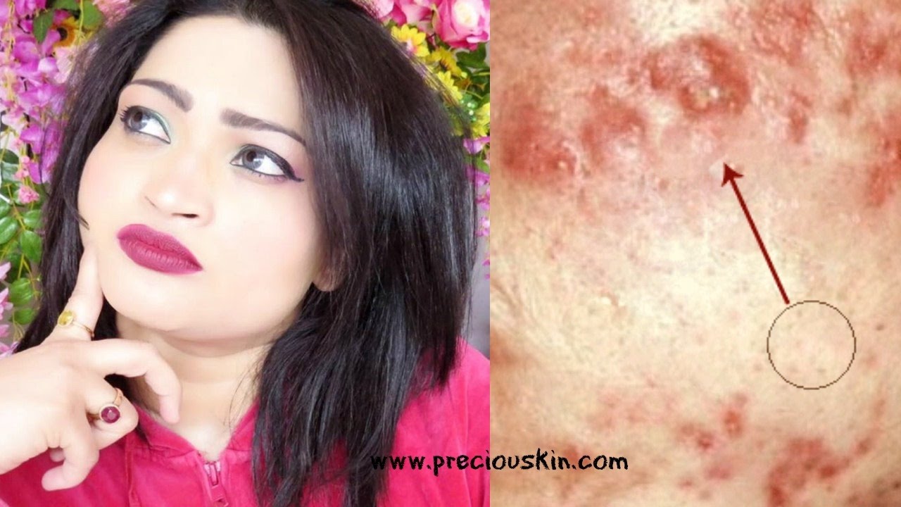 HOW TO GET RID OF ACNE / RASHES PERMANENTLY | Know the ROOT CAUSE | - YouTube