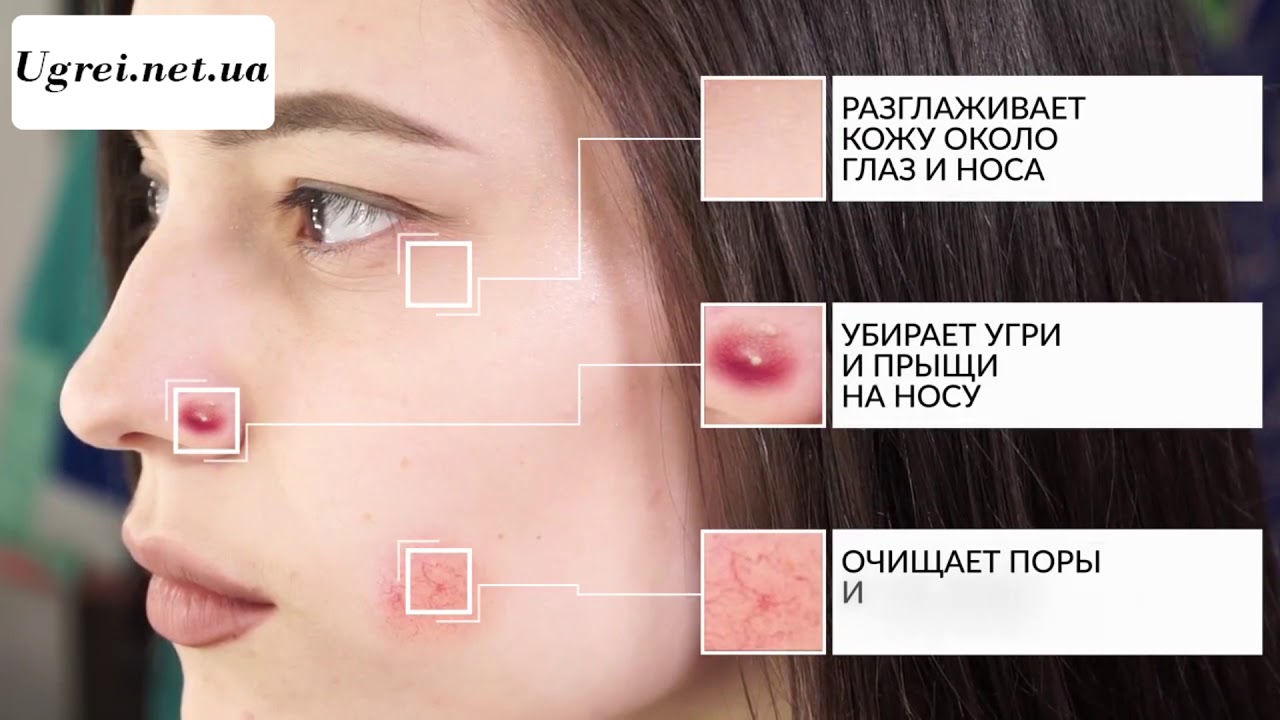 Что такое вакуумная очистка лица?