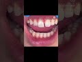#dentalartistry #viral #dentist #diastema #fyp #explore #teethgap #teethcare #dental #dentalhealth