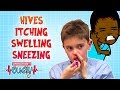 The Signs of Allergic Reactions | Operation Ouch | Science for Kids