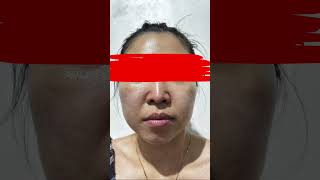 First day using SKINOREN azelaic Acid #viral #dermatology #skincare #azelaicacid #skincareroutine