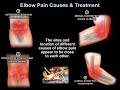 Elbow Pain Causes & Treatment - Everything You Need To Know - Dr. Nabil Ebraheim