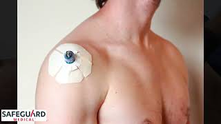 How to Safely Insert the NIO™ Adult IO Access Device In To the Humerus
