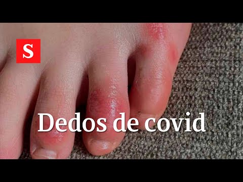 Video: ¿Te pica el covid en los dedos de los pies?