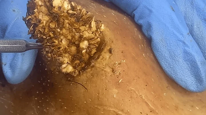 [ASMR] Deep embedded ear blackheads! Dr. Pimple Popper clear remove follicular cysts 2111m1 3493