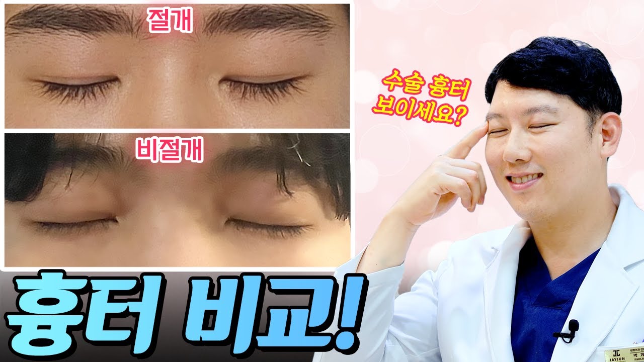 [JAYJUN PHẪU THUẬT THẨM MỸ DA] Rạch VS Không rạch, so sánh cho bạn dù nhắm mắt! ✨Không lo sẹo mổ nữa!✨