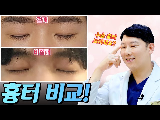 절개 VS 비절개, 눈 감고 비교해드립니다! ✨수술 흉터 걱정 끝!✨