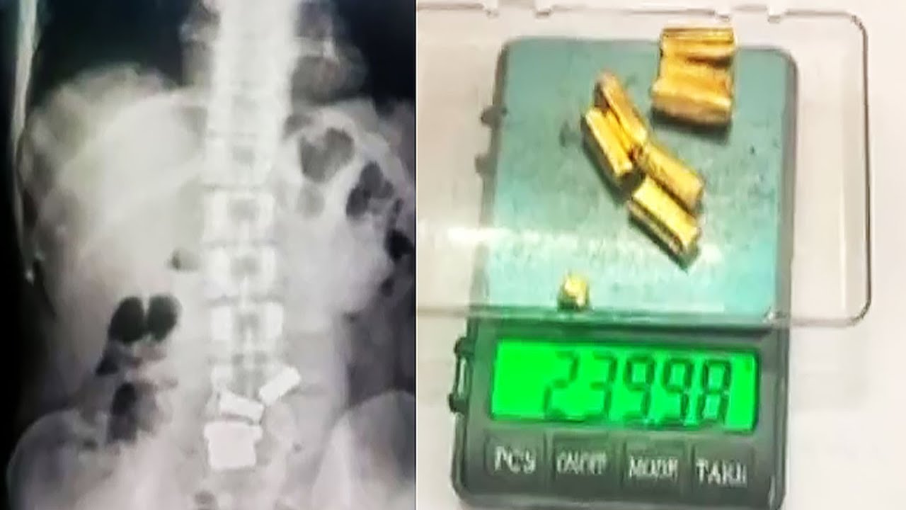 Gold recovered from person's stomach; accused confesses to swallowing 7 gold pieces