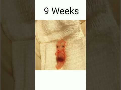 7 Weeks to 10 Weeks pregnancy baby abortions😥#shorts#malayalam #viral #trending #pregnancy
