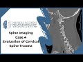 Spine imaging case 4 evaluation of cervical spine trauma