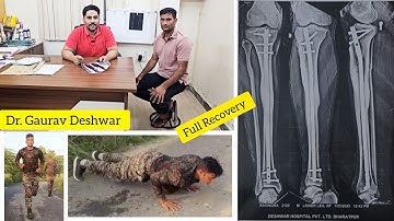 Full Recovery of Tibia fibula bone fracture #fracturetreatment #fracturerecovery #bonehealing 
