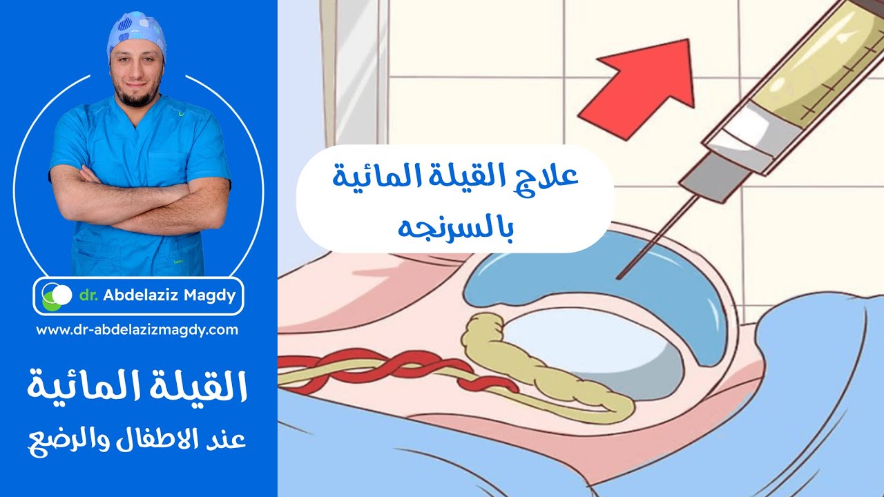 علاج القيلة المائية بالسرنجه