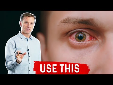 Best Natural Pink Eye (Conjunctivitis) Remedy