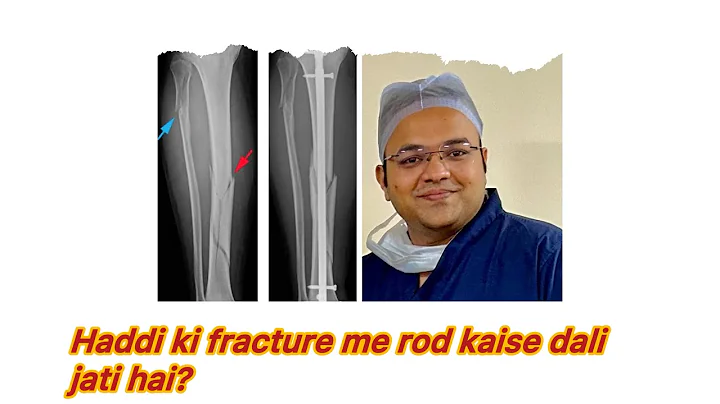 HADDI KI FRACTURE ME ROD KAISE DALI JATI HAI# TIBIA NAILING # FRACTURE ME ROD DALNA # NAILING