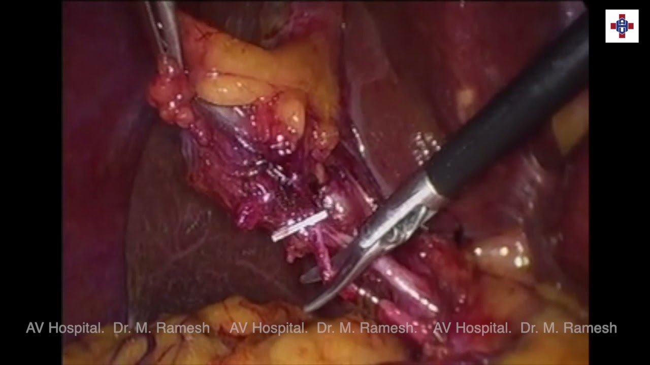 CALLOTS’ TRIANGLE DISSECTION