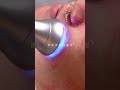 My boyfriend came to Fuding for tourism, and his pores were really oily, so a thorough cleansing