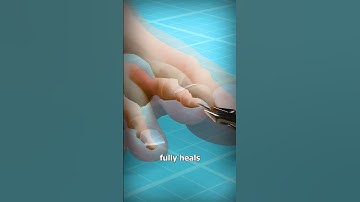 Thumbnail of How To Fix Hammertoe 😷