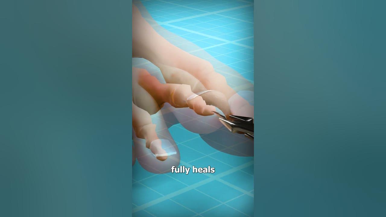 How To Fix Hammertoe 😷