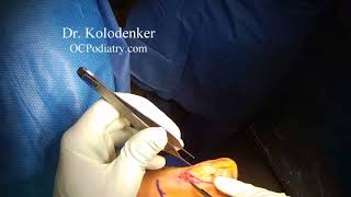 Big Toe Polydactyly Repair Correction Surgery In An Adult