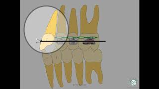 Biomechanics 3(how to achieve various tooth movements)