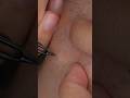 054 ちょっと埋もれてた A little buried hair#tweezers #毛抜き #hairremoval
