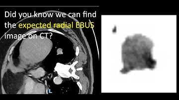 Airway Mapping Made Easy! (Bronchial Branch Tracing): Revisiting the radial, RB10